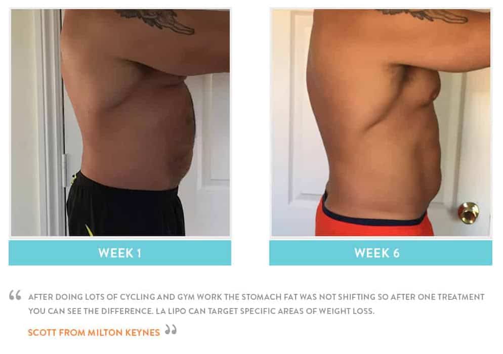 Before & After Stomach Fat Wimbledon