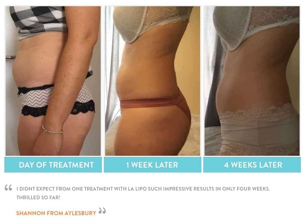 before, Cryolipolysis Wimbledon