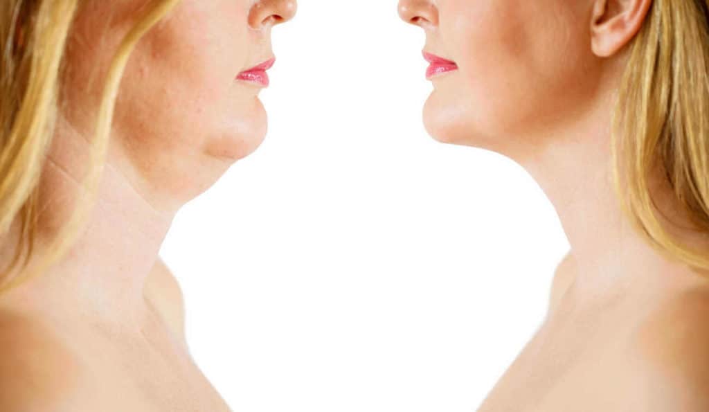 Double Chin treatment Wimbledon before and after results