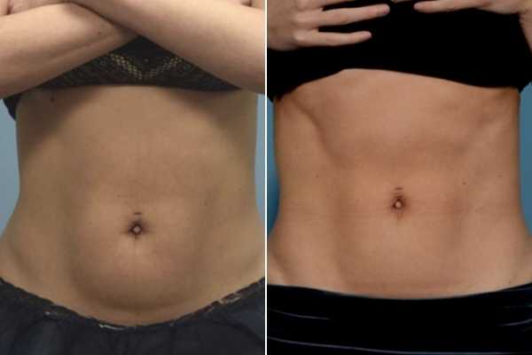 body sculpting FAQs Wimbledon