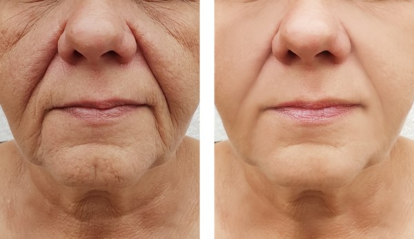 Learn more about Morpheus8 Treatment Wimbledon today!