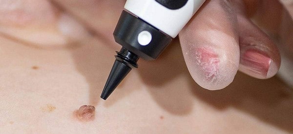 After Skin Tag Removal Wimbledon