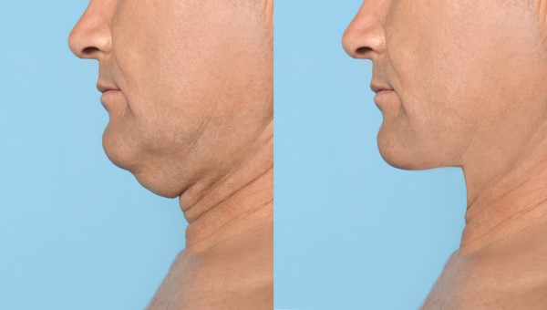Which Non-Surgical Treatments Work Best for Jowls and Loose Skin Wimbledon?
