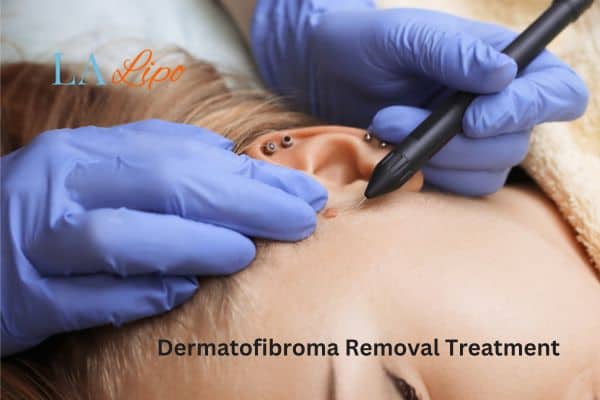 Dermatofibroma Removal Treatment Wimbledon
