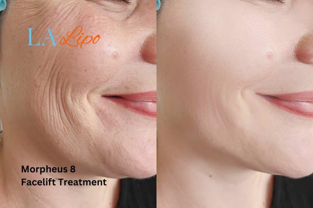 Morpheus8 Treatment Wimbledon for flawless skin! Call us today!