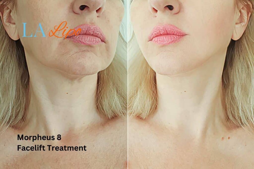 Turn back time with Morpheus8 Treatment Wimbledon