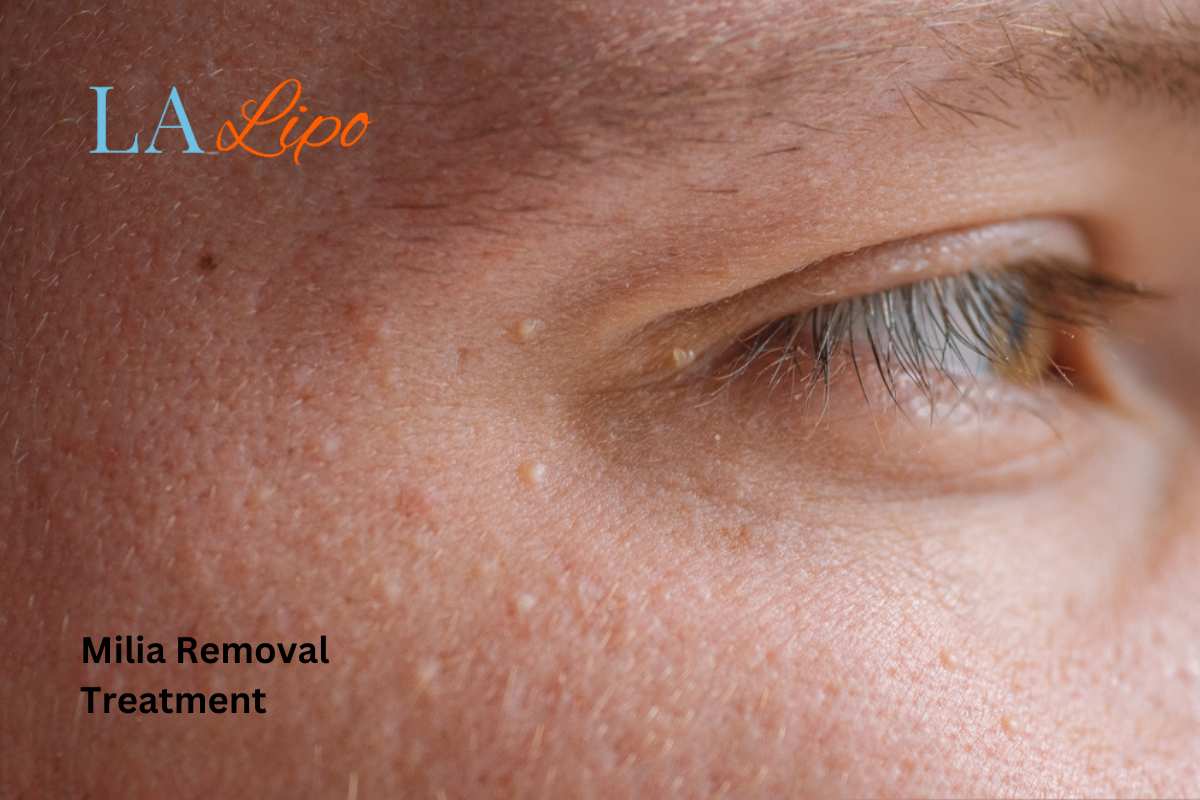 Cryopen Milia Removal: Is It the Easiest and Safest Option Wimbledon?