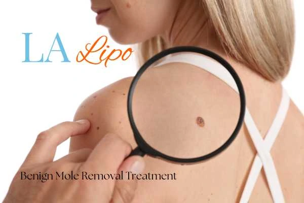 Woman having her inspection of blemish before mole removal Wimbledon