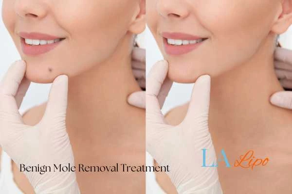 woman's before and after mole removal Wimbledon results