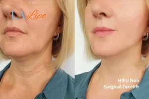 hi-fu for wrinkles Wimbledon before and after results