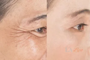Before and after results of woman - HI-fu wrinkles reduction treatment Wimbledon