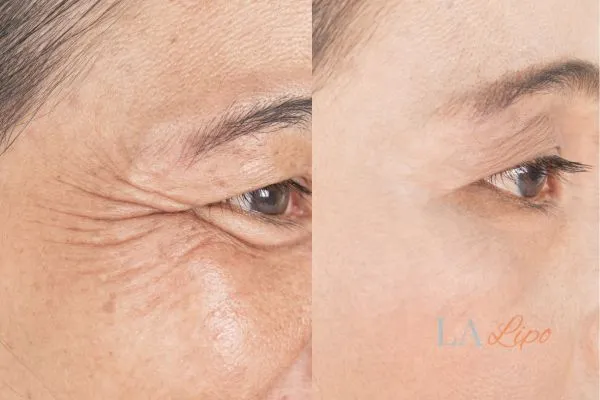 Before and after results of woman - HI-fu wrinkles reduction treatment Wimbledon