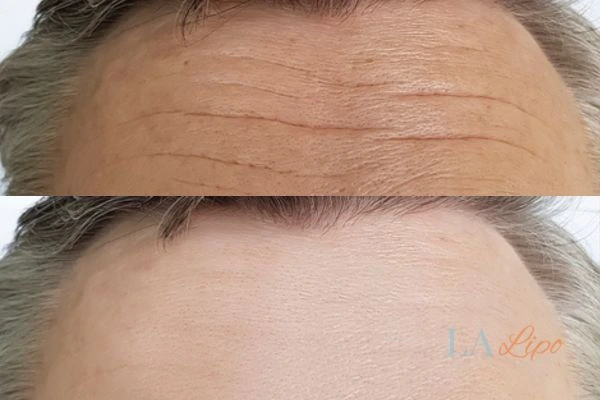 results of HIFU Wimbledon on mans forehead to help reduce lines and wrinkles