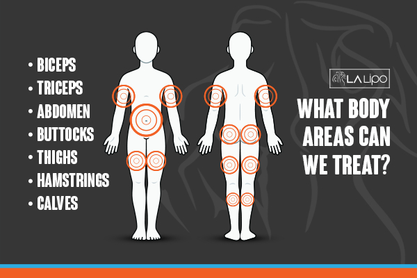 Graphic to show areas you can have LA-EMS Body Sculpting Wimbledon treatment.