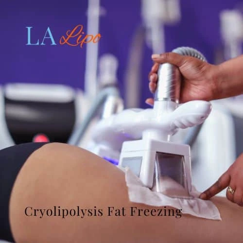 fat freezing - Cryolipolysis Wimbledon
