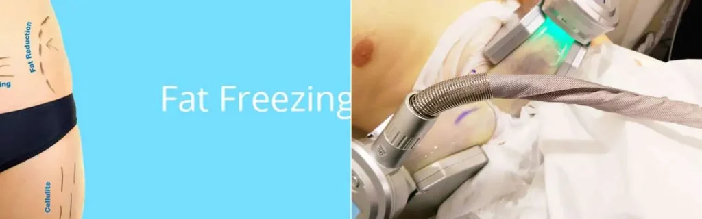 multi areas of a persons body having coolsculpting Wimbledon treatment