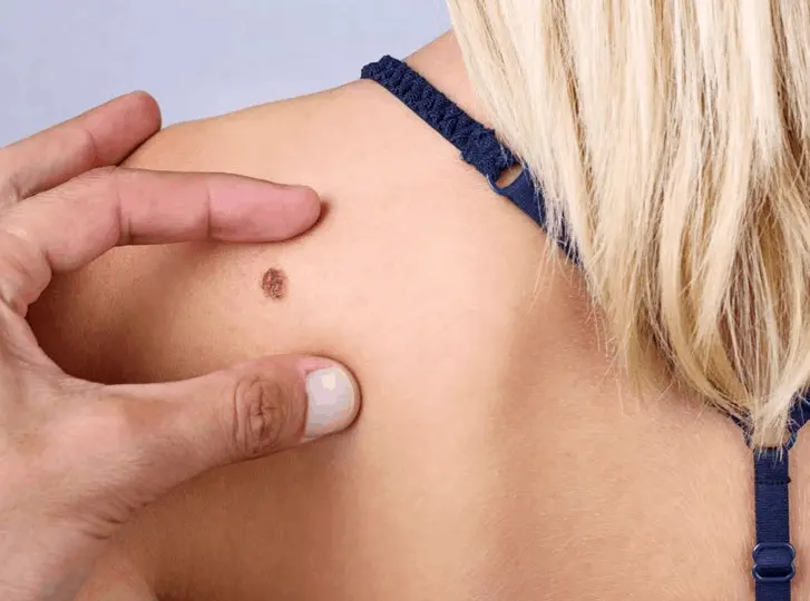 woman having mole removal Wimbledon consultation before treatment.