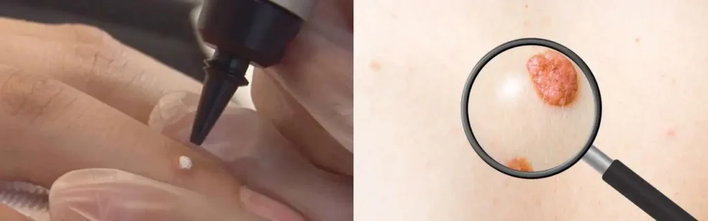 Cryopen for mole removal Wimbledon - speak to our team today!