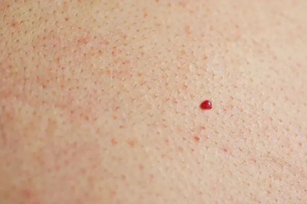 close up of a cherry angioma Wimbledon