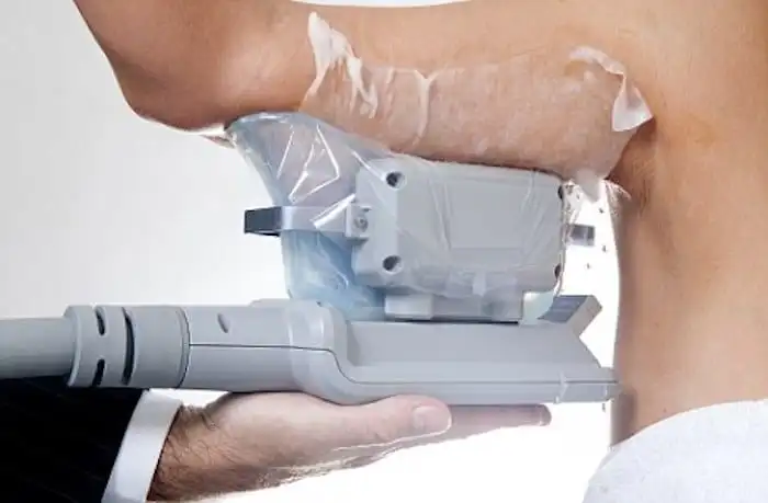 Picture of fat freezing Wimbledon on the upper arms.