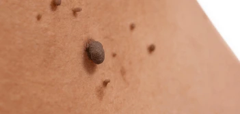 image of a skin tag Wimbledon