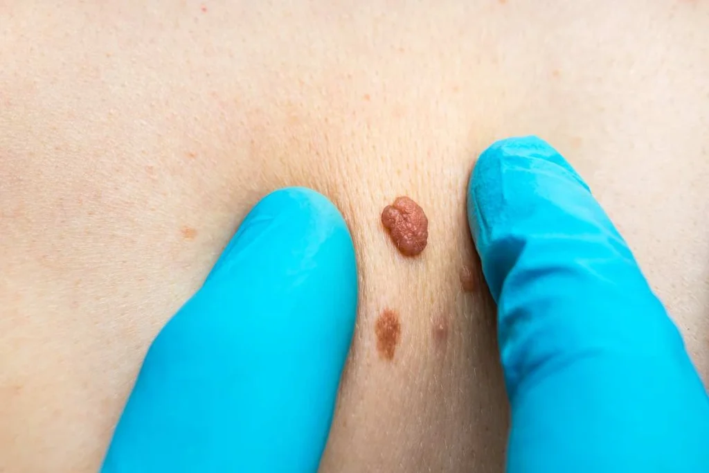 Consultant examining a skin tag Wimbledon