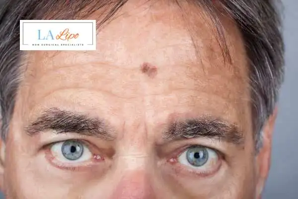 Solar Lentigo Removal Wimbledon image of man with mark on his forehead