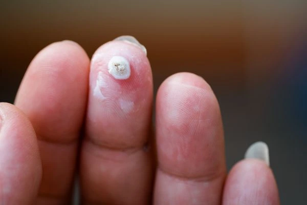 wart on person finger - cryotherapy to treat from LA LIPO Wimbledon