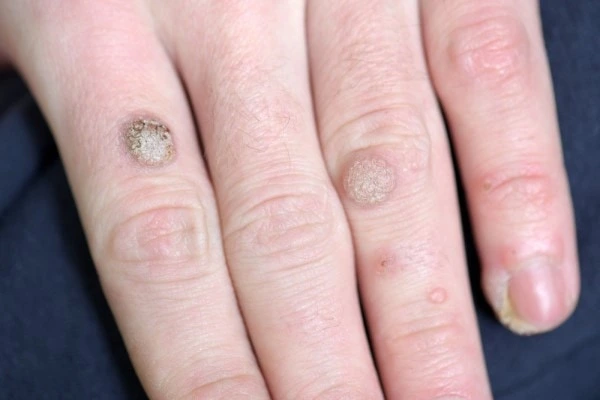 photo of warts on person hand - see wart removal Wimbledon from LA LIPO