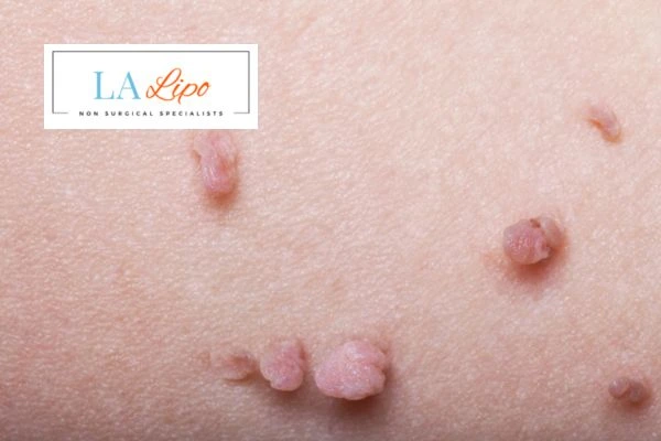 Does cryopen skin tag removal Wimbledon hurt? Find out now call our team today!