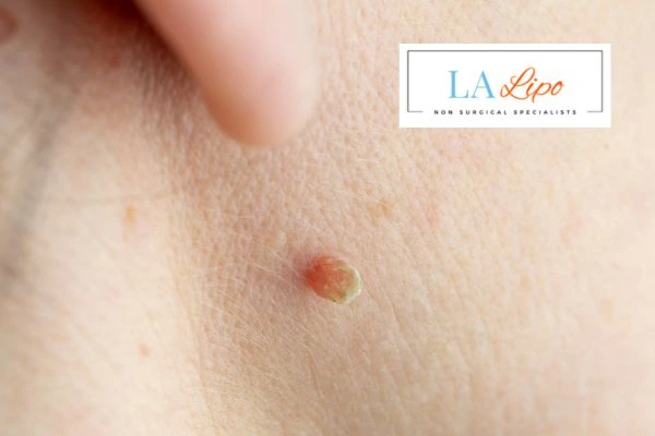Book skin tag removal Wimbledon today speak to our team now!