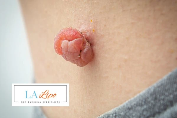 Interested in skin tag removal Wimbledon? Concerned about the pain? Find out more today!