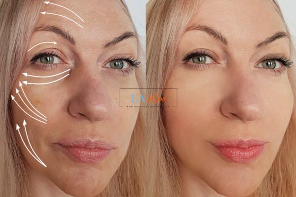 Morpheus 8 results Wimbledon face lift.