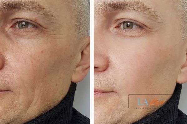 See the amazing results of Morpheus8 Treatment Wimbledon!