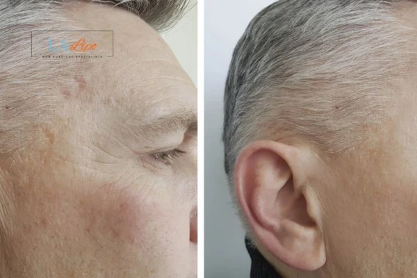 Mens Before & After Morpheus 8 Results Wimbledon