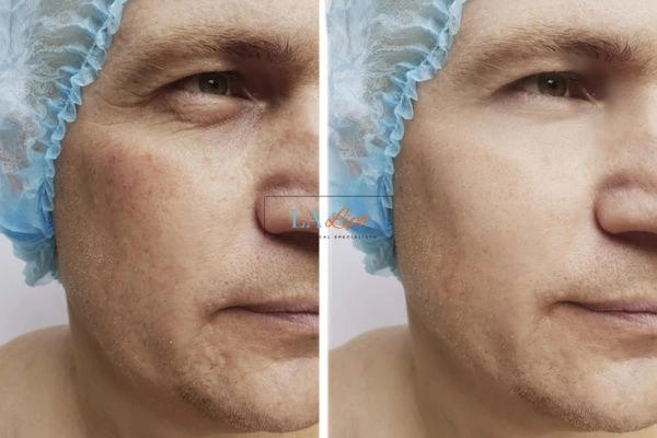 Before and after Morpheus 8 Results Wimbledon