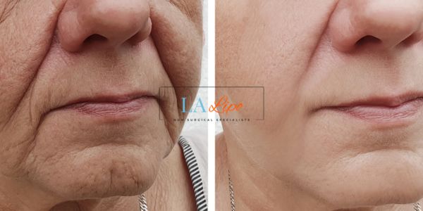 Older lady deeper wrinkle reduction - LA LIPO Morpheus 8 Results Wimbledon