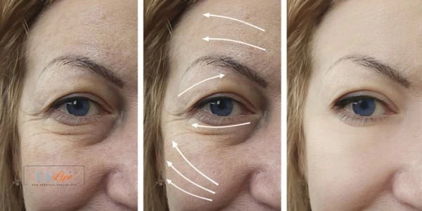 Amazing eye lift Morpheus 8 results Wimbledon
