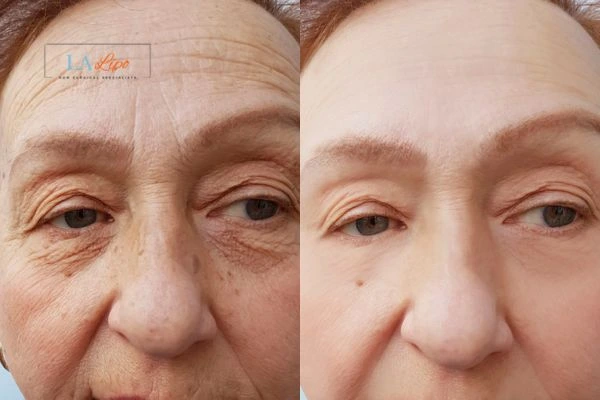 The powerful benefits of Morpheus8 Treatment Wimbledon - Call Our team today!