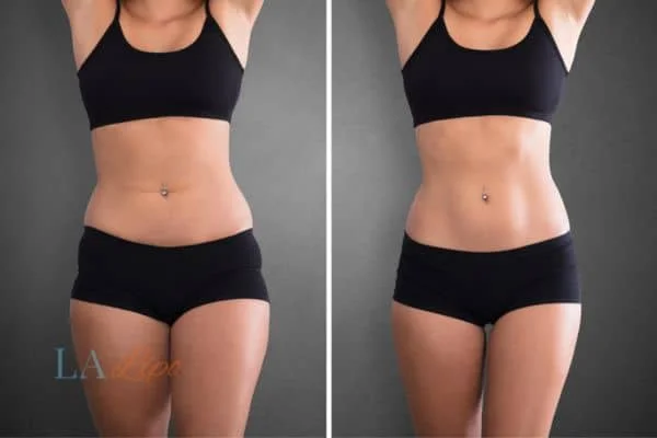 before and after results of non-surgical treatment to help a woman's body image and mental health Wimbledon