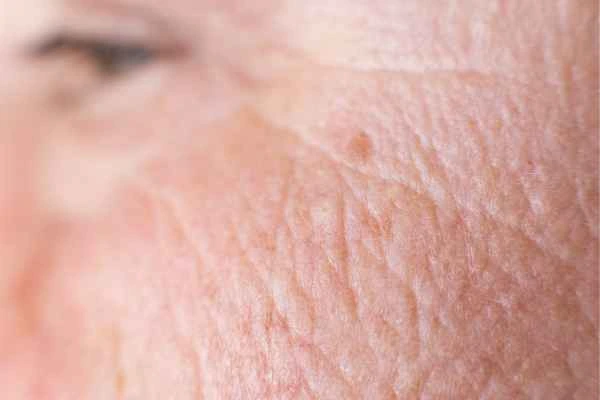 close up picture of a woman's face showing an age spot Wimbledon