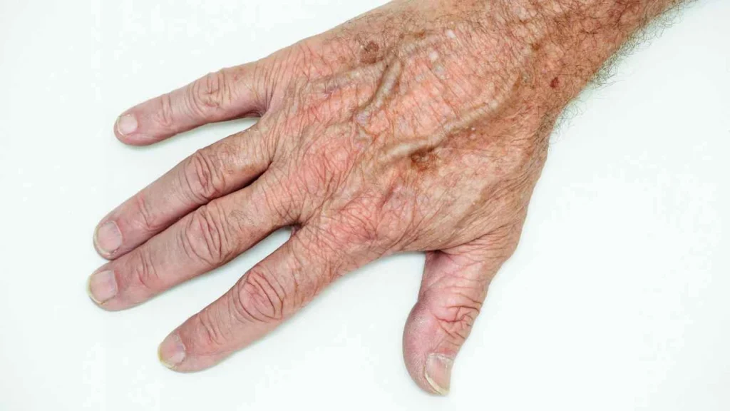 Male hand showing age spot Wimbledon