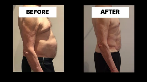 What Symptoms Can Diastasis Recti Cause in Men? Weak Core, Back Pain and Poor Posture Wimbledon